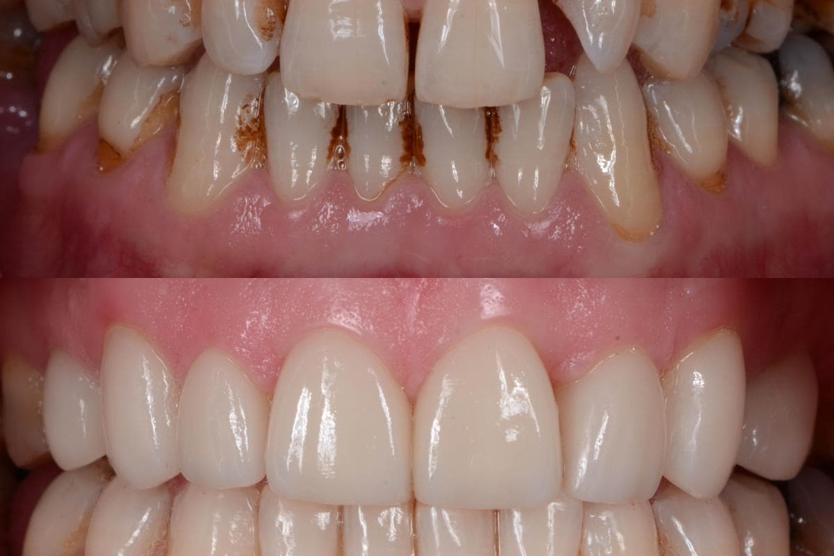 Dental Veneers