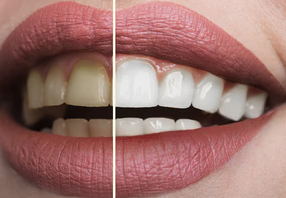 Teeth Whitening
